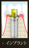 インプラント